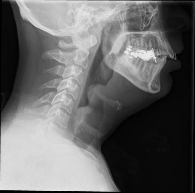 What can you see in this lateral soft tissue X ray of the neck?