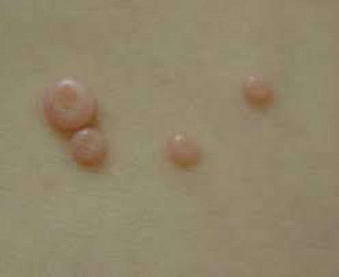 What are the symptoms of molluscum contagiosum?