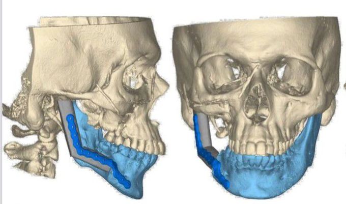 Virtual Surgical Planning