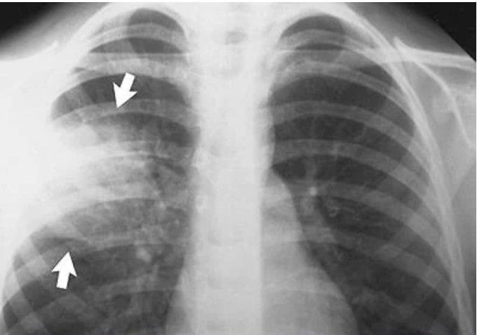 Pneumonia x ray