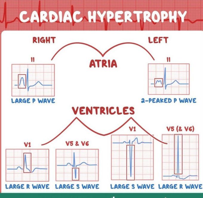 Cardiac Hypertrophy