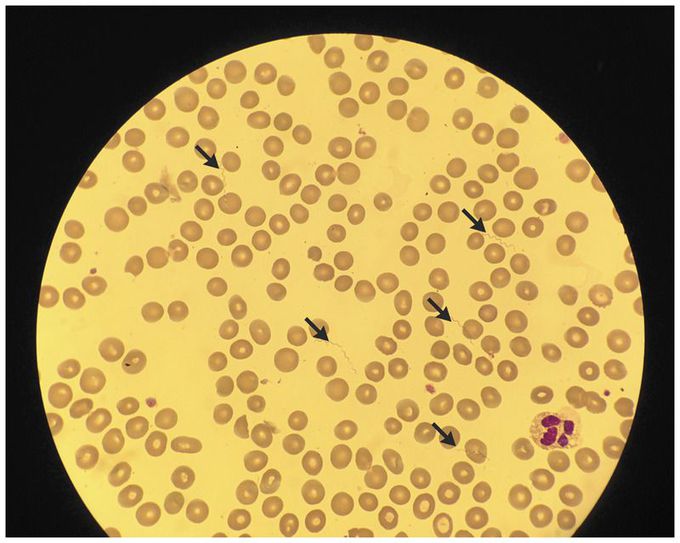 Borrelia recurrentis Infection