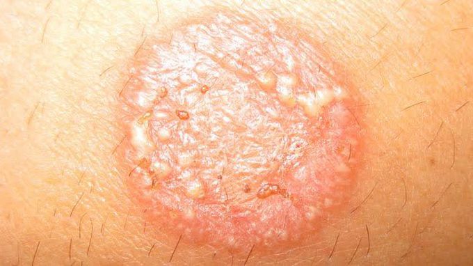 Tinea Corporis - MEDizzy