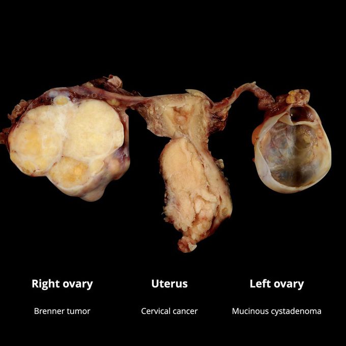 Brenner Tumor