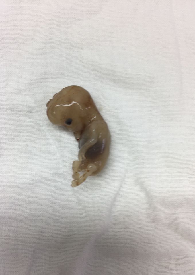 Twenty weeks of pregnancy