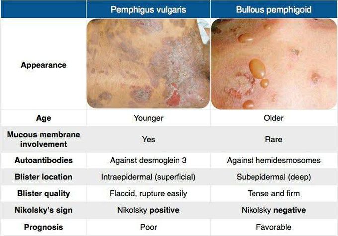 Pemphigus Vulgaris and Bullous Pemphigoid