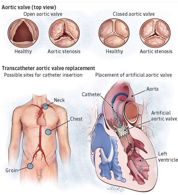 Aortic valve replacement