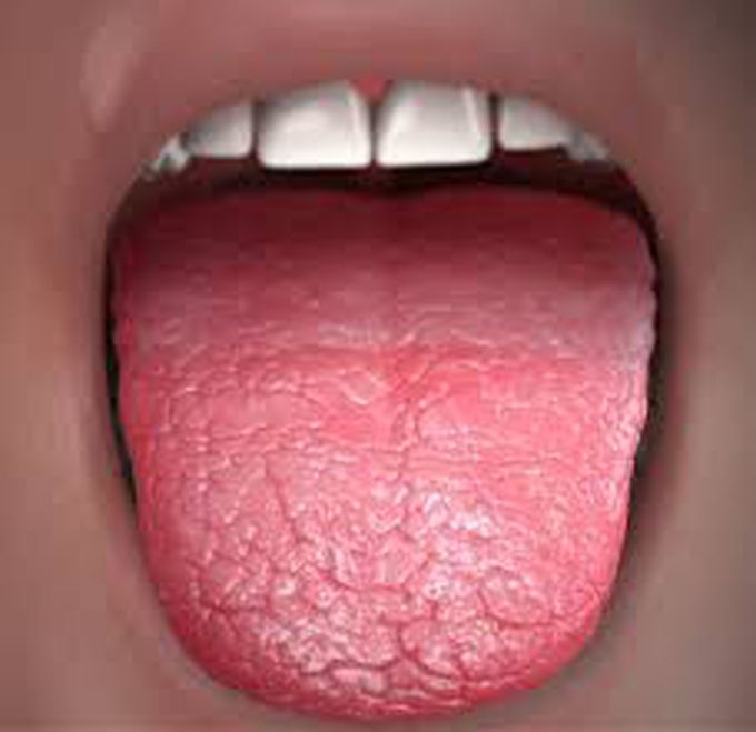 Causes of dry mouth
