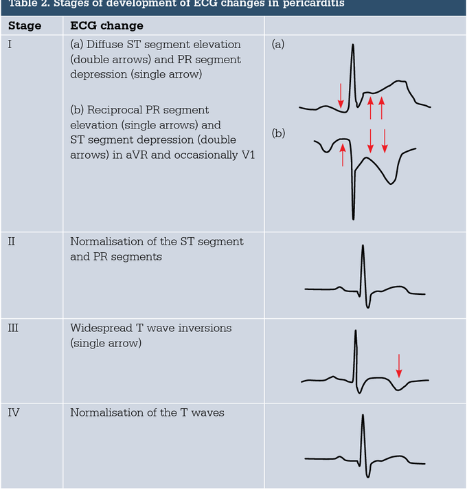 Satges of ECG changes in Pericarditis