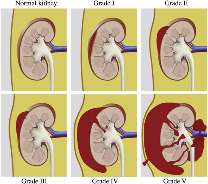 Grades of Acute Renal Trauma