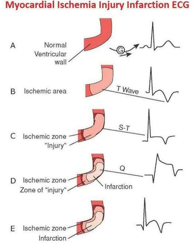 Myocardial Ischemic Injury Infarction