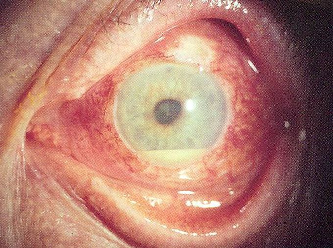 Hypopyon