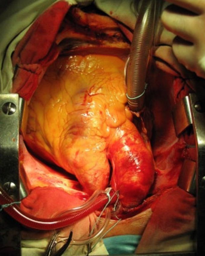 Ascending aortic aneurysm!!! 