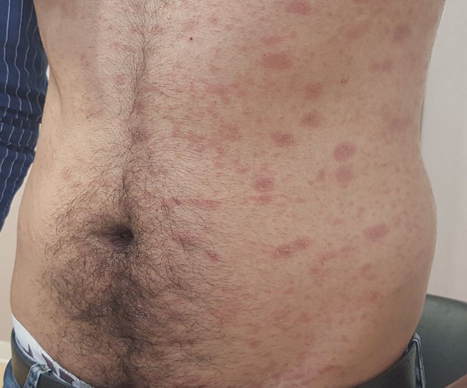 Skin eruptions  with itching  suddenly