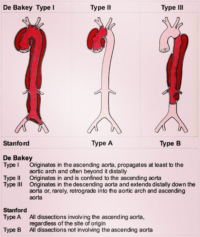 Aortic Dissection