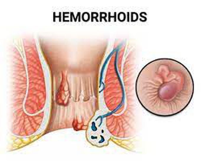 Hemorrhoids