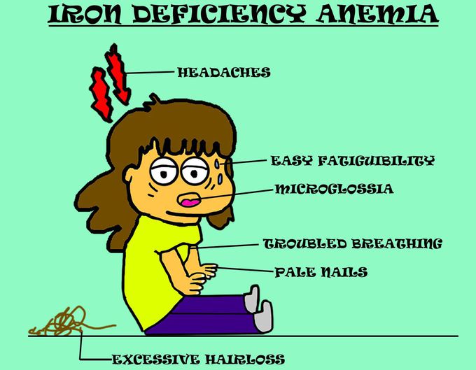 Iron deficiency anemia