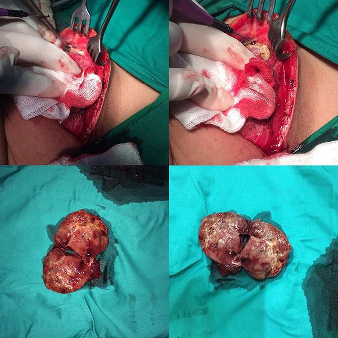 Tyroidectomy