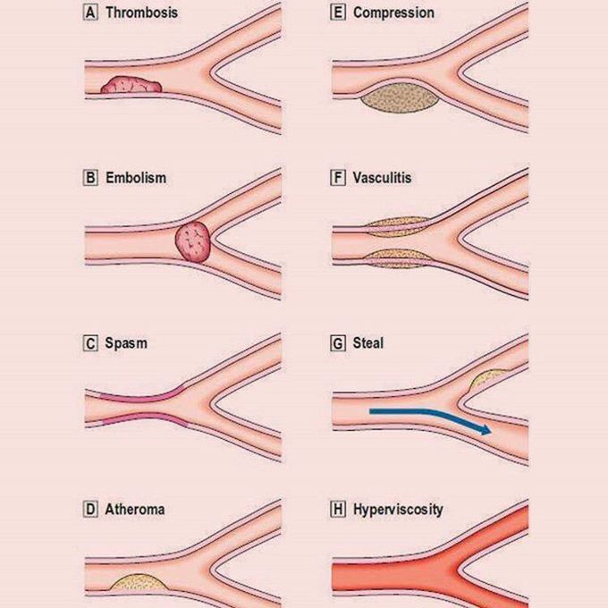 Various pathological processes that may occur in the blood vessels...