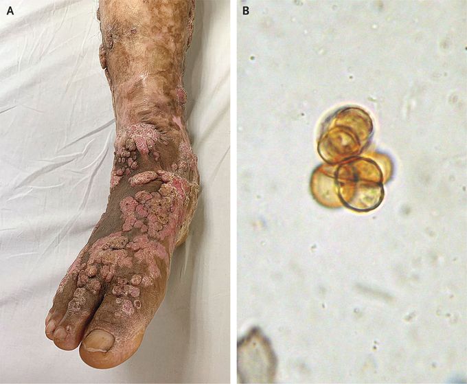 Chromoblastomycosis