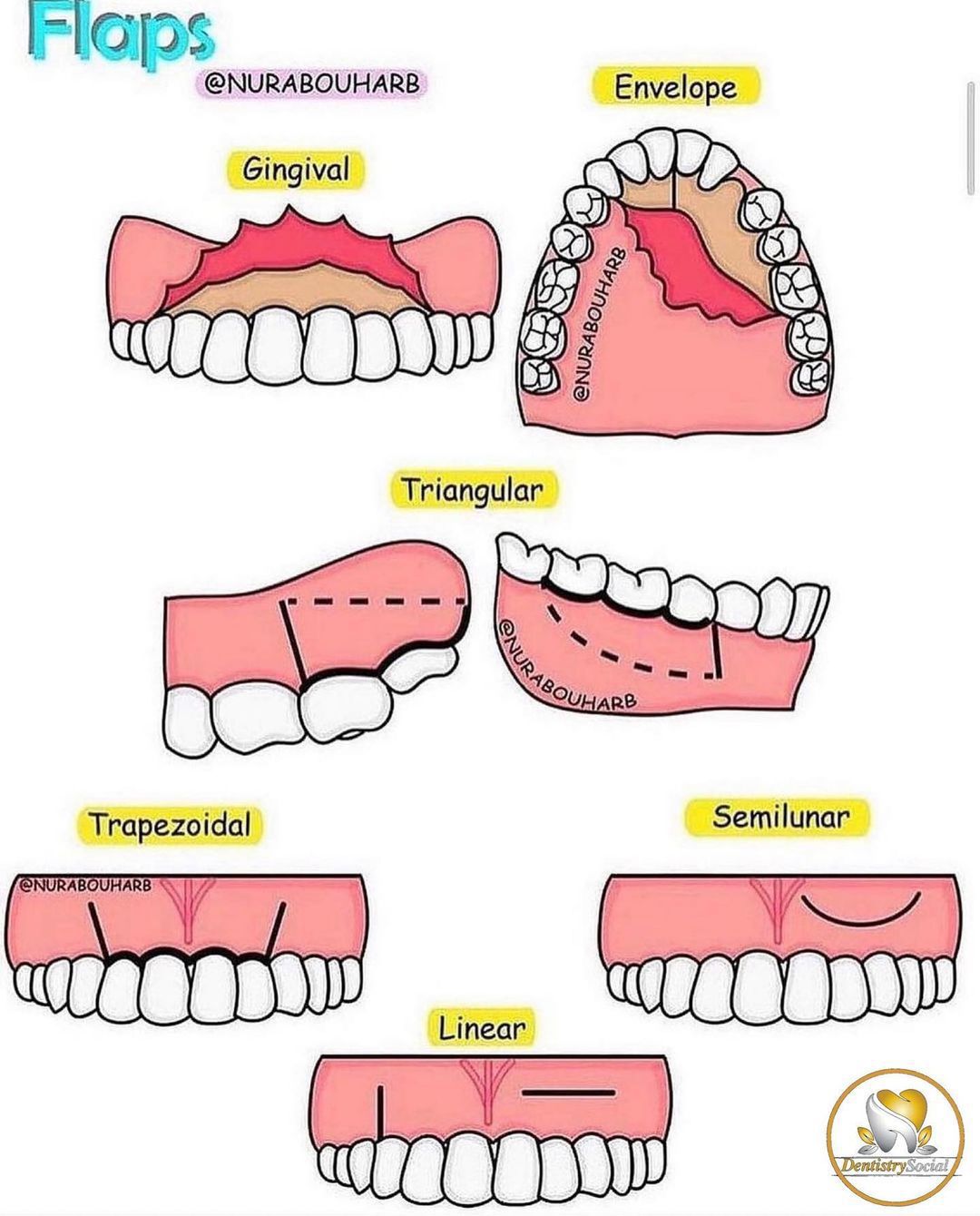 Types of flaps in oral surgery