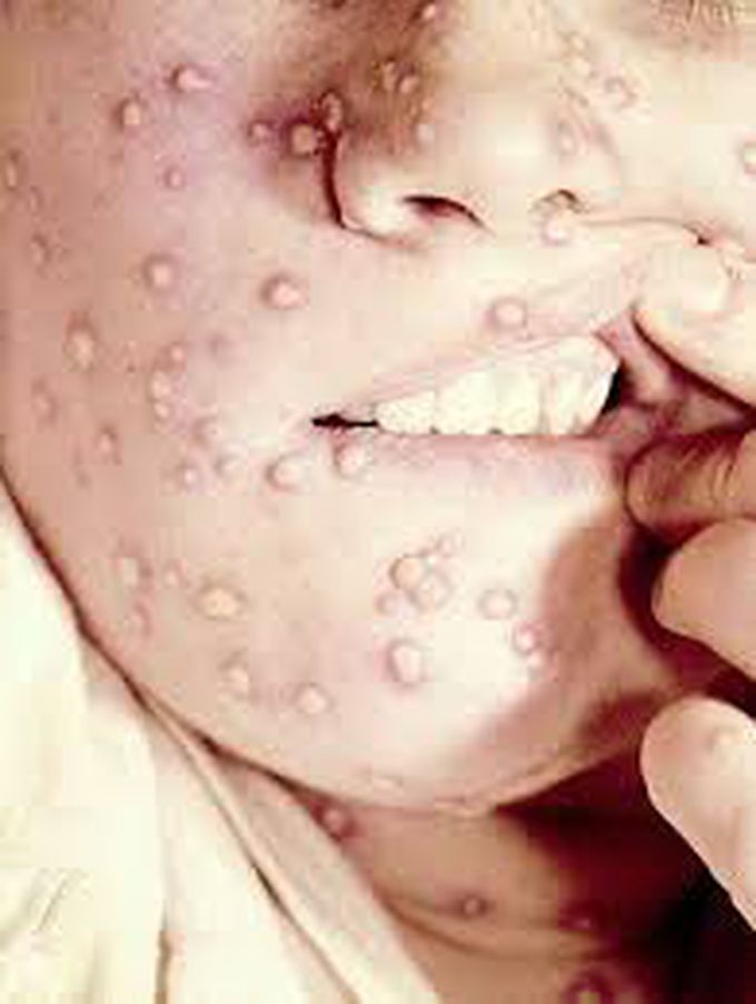 #_Monkeypox disease