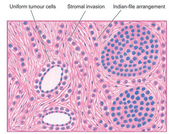 Invasive lobular carcinoma