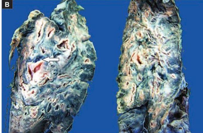 Bronchiectasis of the lung