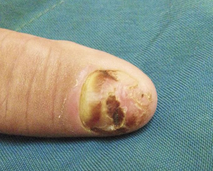 Squamous-Cell Carcinoma of the Nail Bed