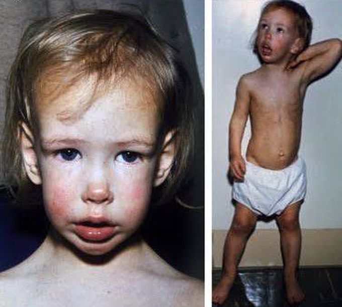 Soto Syndrome