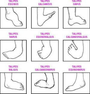Types Of Club Foot Medizzy