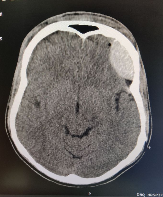 Epidural Hematoma