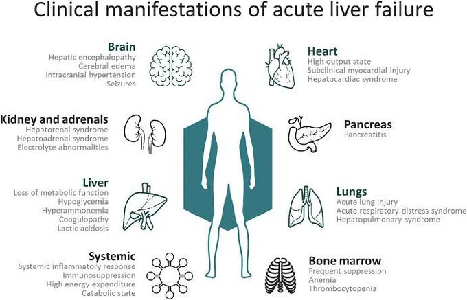 Acute liver failure