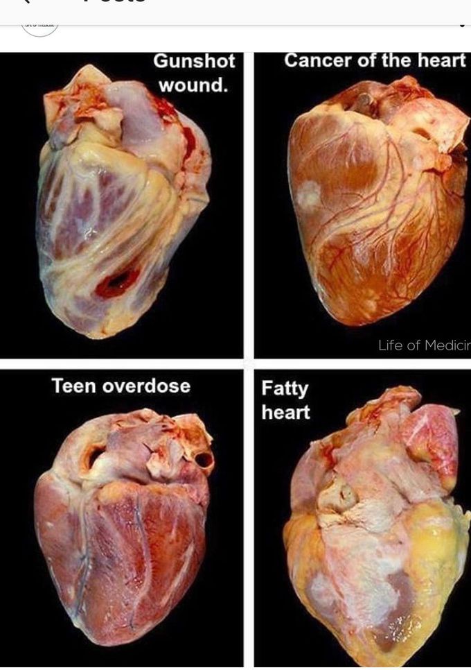 Different condition of the heart