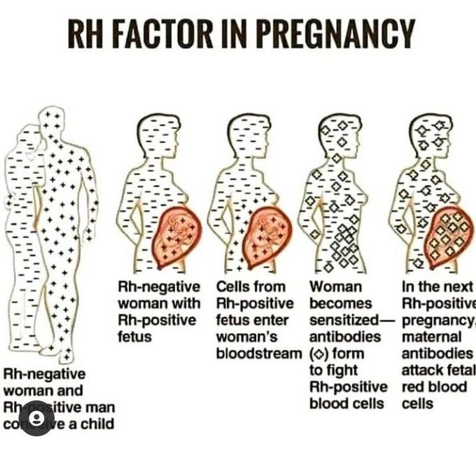 Rh factor in pregnancy