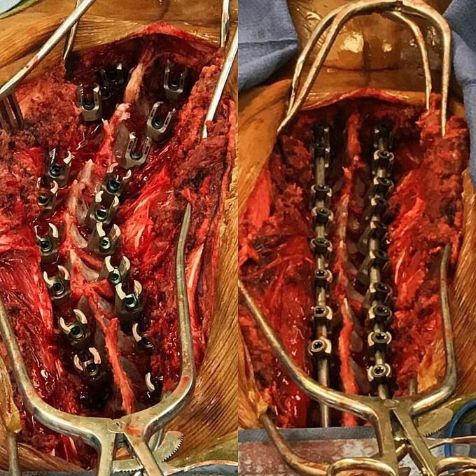 Intraoperative view of scoliosis surgery, before and after alignment!!