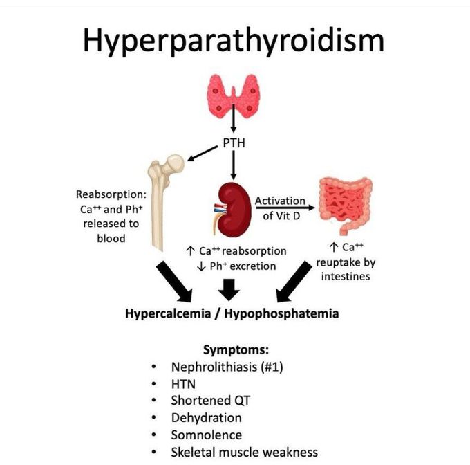 Hyperparathyroidism