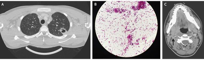 Lemierre’s Syndrome