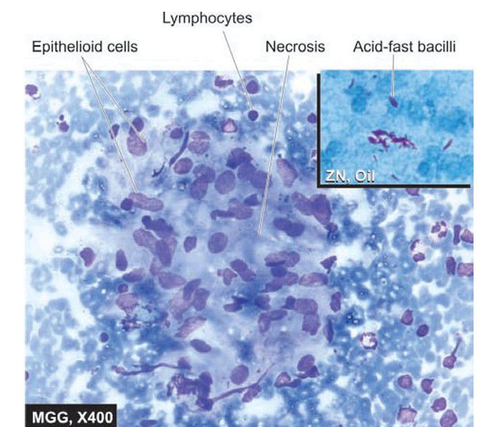 Tuberculous lymphadenitis.