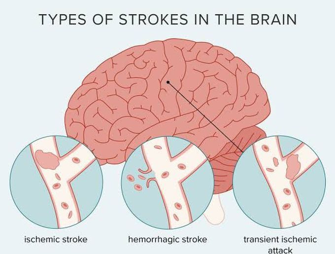 Types Of Strokes MEDizzy