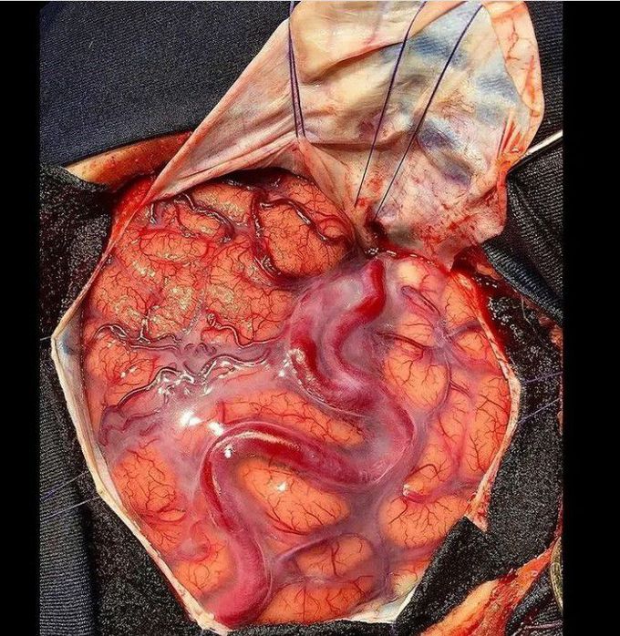 Cerebral Arteriovenous Malformation