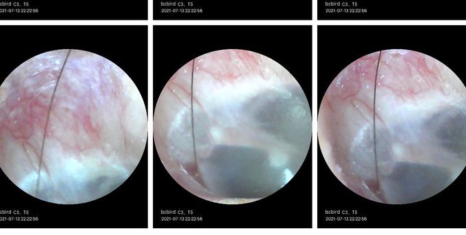 Foreign object (hair) in ear canal