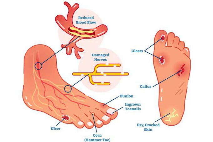 Diabetic Foot Infections