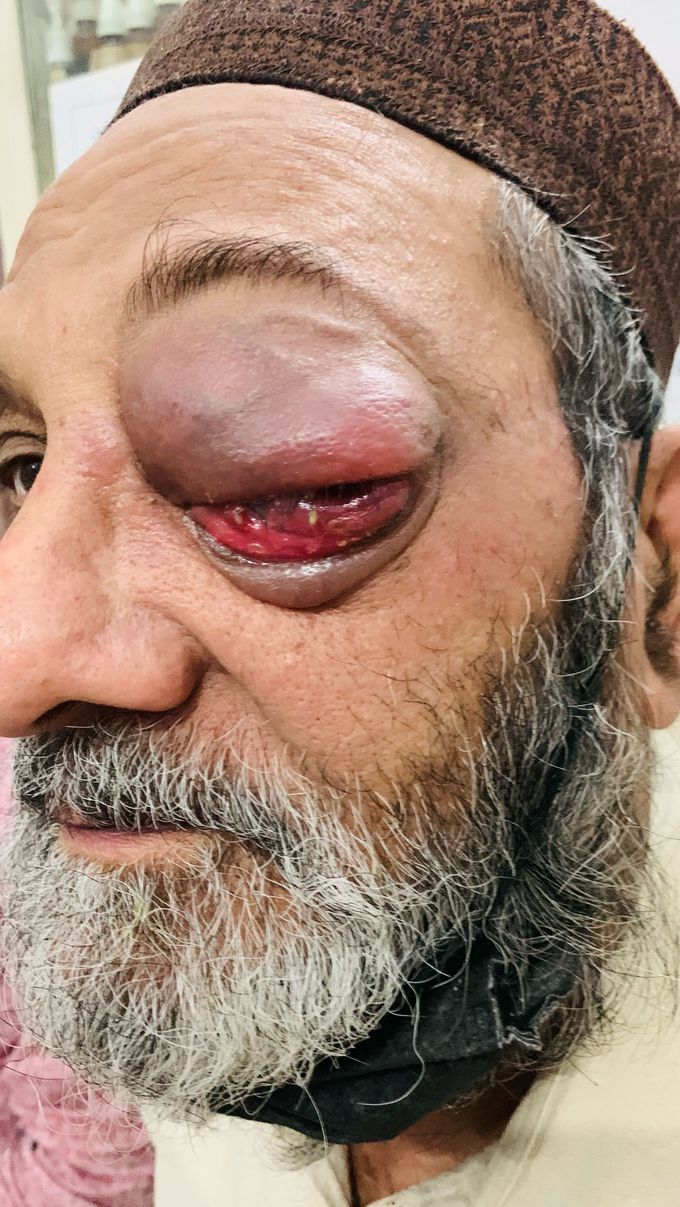 Dx Rx eye sweelling pain