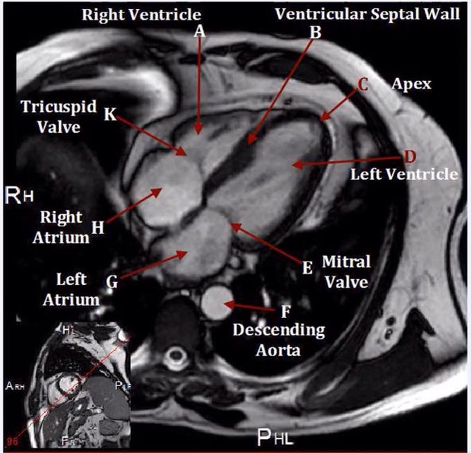 4-chamber Cardiac Balanced Steady-State Free-Precession (BTFE / True-FISP / FIESTA) - anatomy