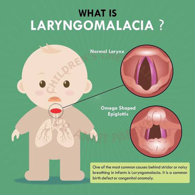 Laryngomalacia