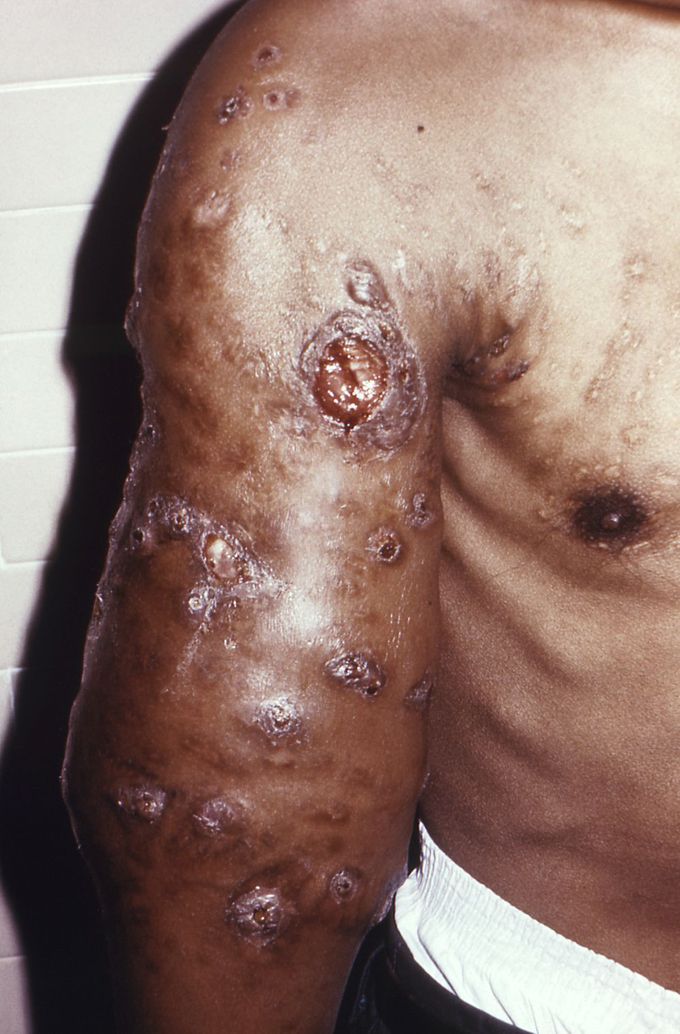 Nocardia diseases