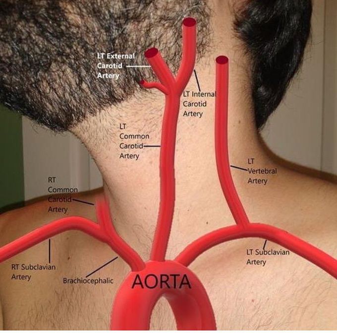 Aortic Arch