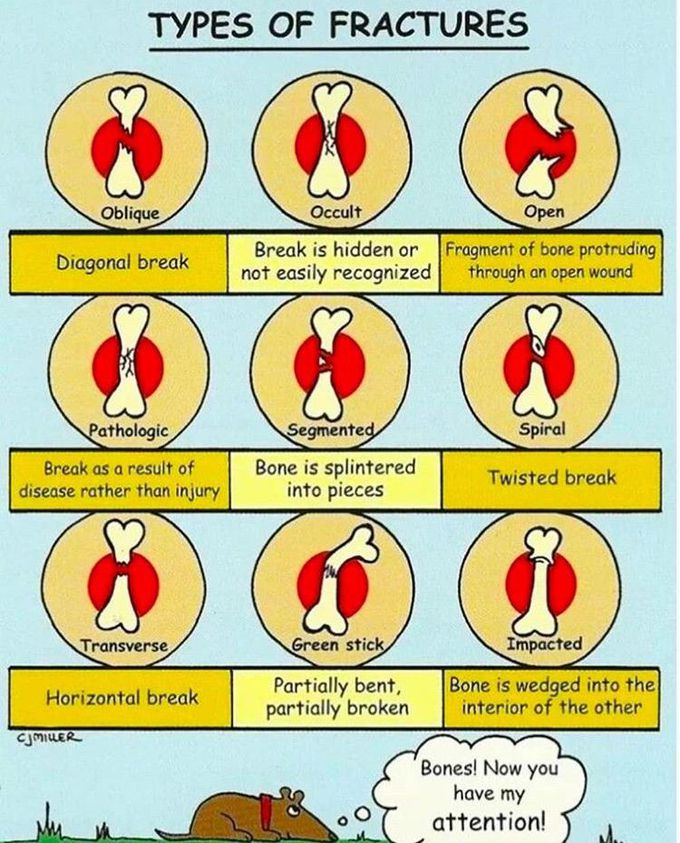 Fracture types