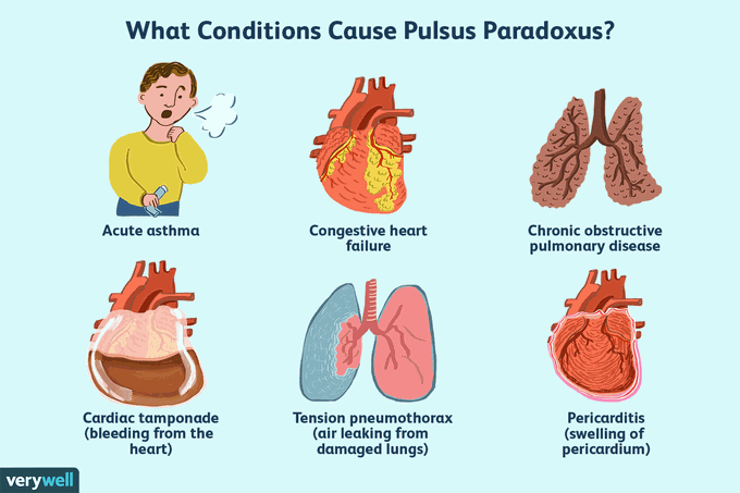 What causes pulsus paradoxus?
